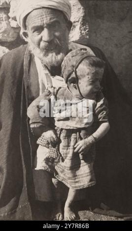 Anti-smallpox campaign Dawaimeh-Hebron in Palestine, January - February 1922: Eruption on an inoculated child. Stock Photo