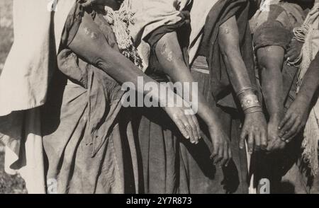 Anti-smallpox campaign Dawaimeh-Hebron in Palestine, January - February 1922: Successful vaccinations (Cairo Lymph). Stock Photo