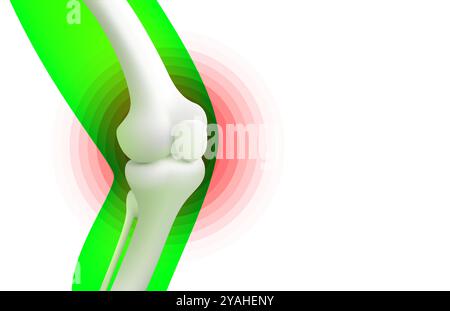 knee pain, X-ray of the leg, 3D visualization. Vector Stock Vector ...