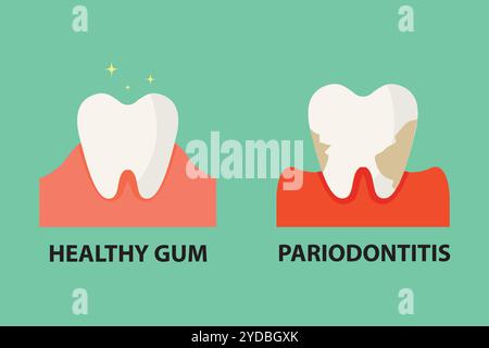 Stomatological concept. Comparison between healthy tooth and periodontitis tooth. Vector illustration. Stock Vector