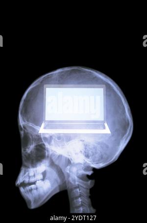 Radiograph of the brain Stock Photo