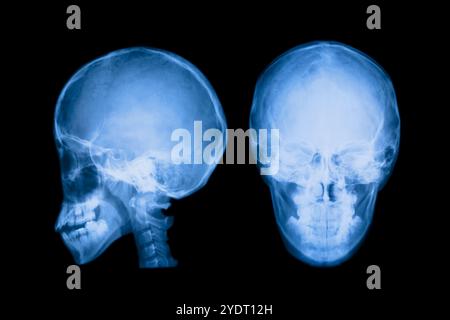 Radiograph of the brain Stock Photo