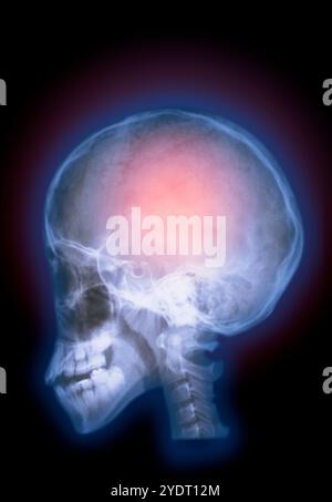Radiograph of the brain Stock Photo