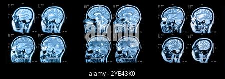 MRI Scan image of a human brain showing all main multiple sclerosis Stock Photo