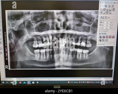 X-ray of the teeth, panoramic image of the entire teeth in the upper ...