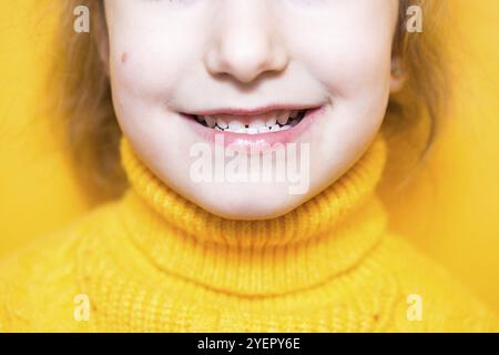 Girl shows her teeth-pathological bite, malocclusion, overbite ...