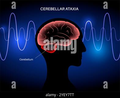 Conceptual illustration of cerebellar ataxia. Ataxia is disorder that ...
