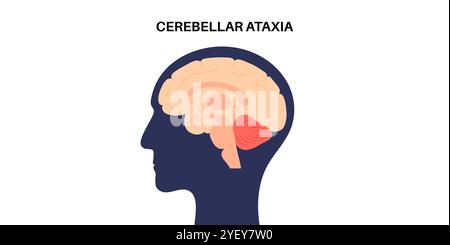 Conceptual illustration of cerebellar ataxia. Ataxia is disorder that ...