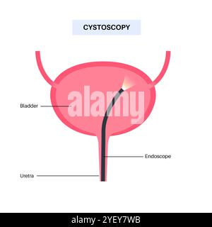 Conceptual illustration of a cystoscopy procedure. This is a procedure used to diagnose, monitor and treat conditions affecting the bladder and urethra. Stock Photo