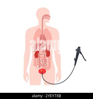 Conceptual illustration of a cystoscopy procedure. This is a procedure used to diagnose, monitor and treat conditions affecting the bladder and urethra. Stock Photo