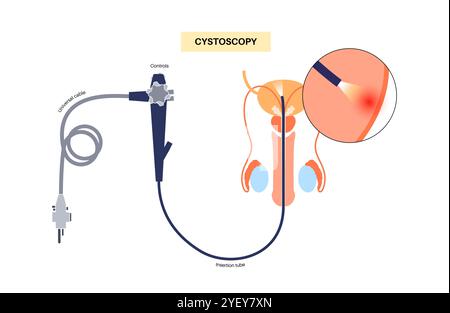 Conceptual illustration of a cystoscopy procedure. This is a procedure used to diagnose, monitor and treat conditions affecting the bladder and urethra. Stock Photo