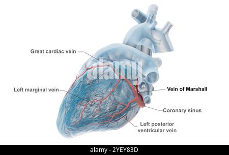 Illustration of coronary veins with the vein of Marshall (dark red) highlighted. The great cardiac vein is seen running across the left ventricle (lower chamber) of the heart. The vein of Marshall, also known as the left atrial oblique vein, is an embryological remnant of the superior vena cava. It is thought to be a source for triggers of atrial fibrillation (AF), an irregular and often abnormally fast heart rate. For an unlabelled version of this image see F043/3534. Stock Photo