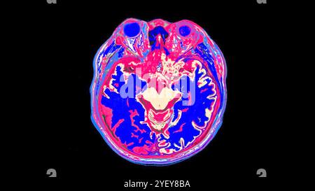 Coloured magnetic resonance imaging (MRI) scan of a healthy human brain. Stock Photo