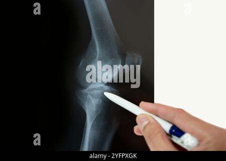 Doctor radiologically analyzing the knee with x-ray Hand of a doctor analyzing and pointing with a pen to the affected area. Stock Photo
