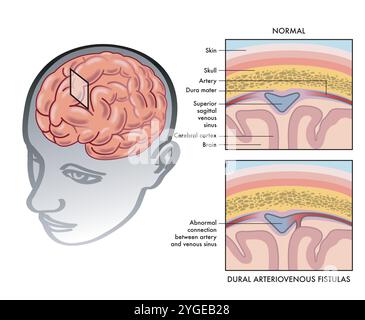 Simple medical illustration showing how a dural arteriovenous fistula occurs in the brain, with annotations. Stock Vector