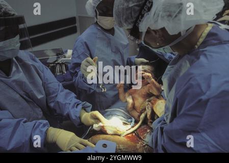 A baby is born by C-section in a hospital in Atlanta, GA Stock Photo
