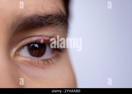 Macro shot close-up of human eye with small stye on upper eyelid, highlighting inflammation and irritation. Health and medical concept for infection s Stock Photo