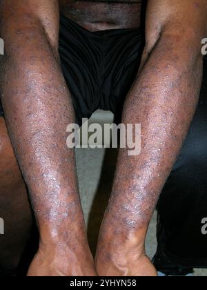 Pustules on the arms of African American male patient with infected atopic dermatitis. Atopic dermatitis, also called atopic eczema, is an inflammatory skin reaction that occurs without any obvious external cause. Broken skin caused by the dermatitis, or by scratching, increases the risk of bacterial infection. Atopic dermatitis can be treated with soothing ointments and corticosteroid drugs. Infection is treated with antibiotics. Stock Photo
