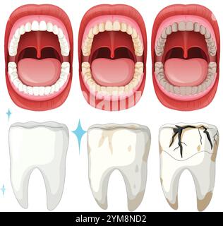 Illustration of healthy and decayed teeth stages Stock Vector
