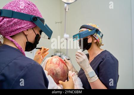 Surgeons conducting a detailed hair transplant procedure on a patient Stock Photo
