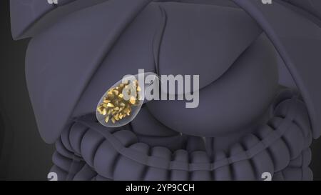 Gallstones Causing Obstruction in Bile Duct System Stock Photo