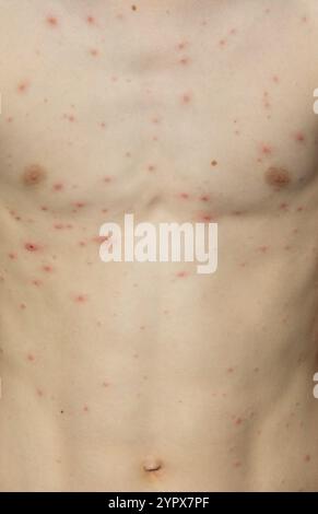 Chickenpox rash on a body of a young boy. Chickenpox is a contagious disease caused by the varicella-zoster virus (VZV) Stock Photo