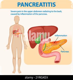 Illustration of pancreas inflammation and related pain Stock Vector