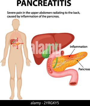 Illustration of pancreas inflammation and related pain Stock Vector