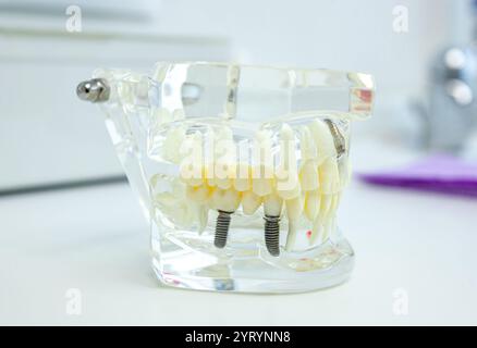 Transparent anatomical model of human jaw with implants showing teeth ...