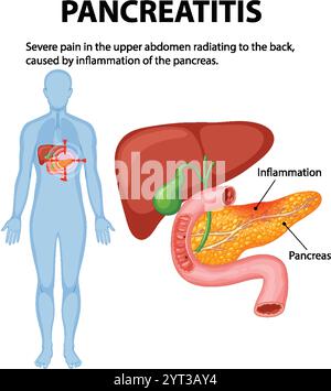 Illustration of pancreas inflammation and related pain Stock Vector