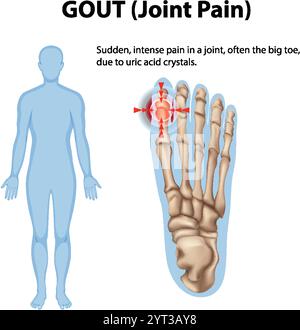 Gout Racgp A Medical Human Anatomy Gout illustration Stock Vector Image & Art - Alamy