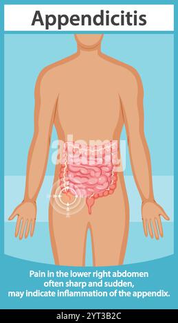 Appendicitis symptoms. Appendix disease abdominal pain infographic ...
