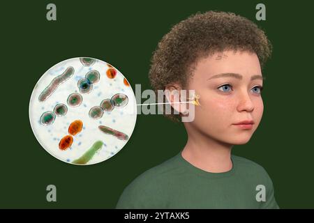 Computer illustration of a child with transparent skin revealing otitis media (middle ear infection) and a close-up view of bacteria that caused it. Stock Photo