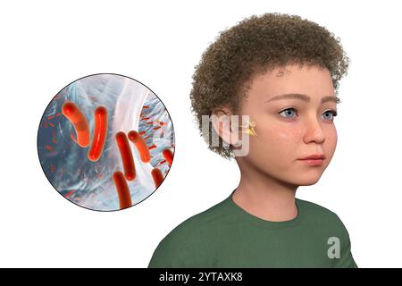 Computer illustration of a child with transparent skin revealing otitis media (middle ear infection) and a close-up view of bacteria that caused it. Stock Photo