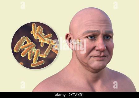 Computer illustration of a man with transparent skin revealing otitis media (middle ear infection) and a close-up view of bacteria that caused it. Stock Photo