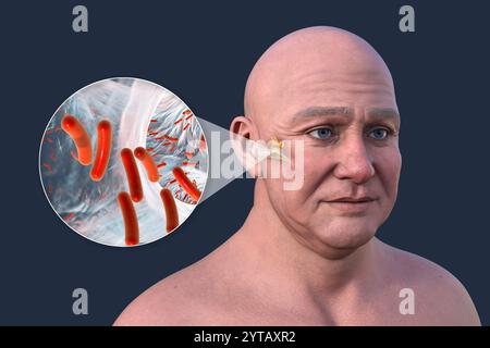 Computer illustration of a man with transparent skin revealing otitis media (middle ear infection) and a close-up view of bacteria that caused it. Stock Photo