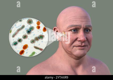 Computer illustration of a man with transparent skin revealing otitis media (middle ear infection) and a close-up view of bacteria that caused it. Stock Photo