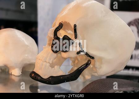 Orthopedic implants and individual titanium cranioplasties printed on a 3D printer Stock Photo