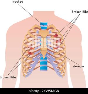 Medical illustration of broken ribs in the human body, with annotations. Stock Vector