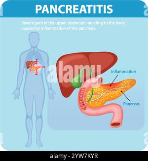 Illustration of pancreas inflammation and related pain Stock Vector