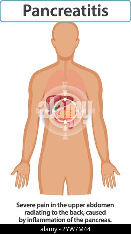 Illustration of pancreatitis affecting the human body Stock Vector