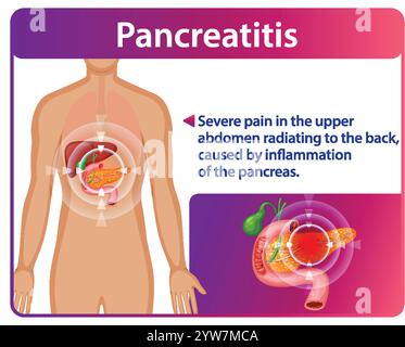 Illustration of pancreatitis symptoms and affected organs Stock Vector