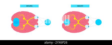Double vision (diplopia), illustration Stock Photo - Alamy