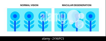 Macular degeneration, illustration. Stock Photo