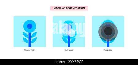 Macular degeneration, illustration. Stock Photo