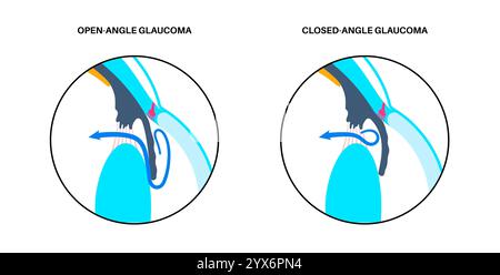 Glaucoma eye disease, illustration. Stock Photo