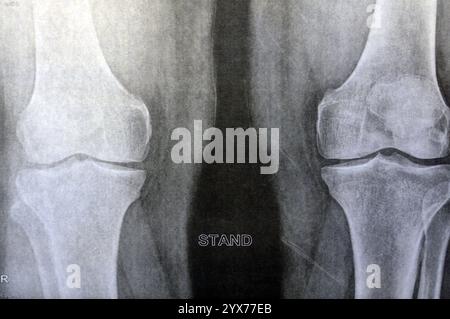 Plain x-ray of the knee showing apparent joint osteoarthritis according ...