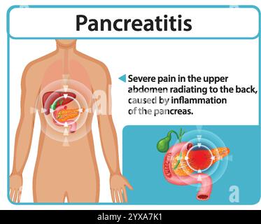 Illustration of pancreatitis symptoms and affected organs Stock Vector