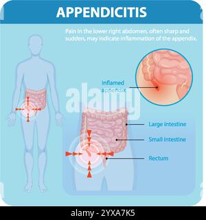 Illustration of appendicitis symptoms and affected organs Stock Vector ...