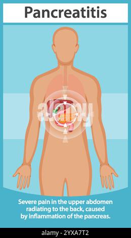 Illustration of pancreatitis affecting the human body Stock Vector